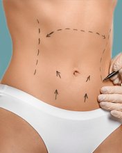 Servicio Abdominoplastía